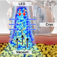 Синергизм LED+Vacuum+Cryo для коррекции фигуры