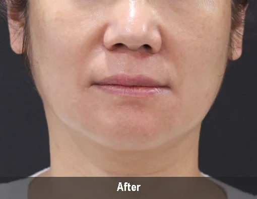 Коррекция овала лица с аппаратом Microson Plus – фото после процедуры