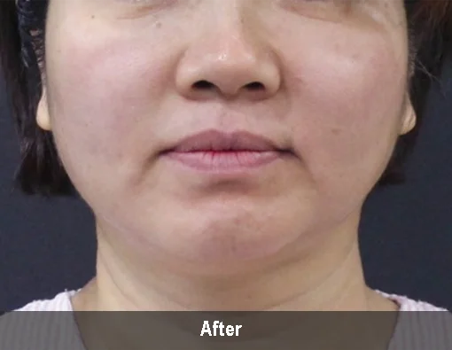 Коррекция овала лица с аппаратом Microson Plus – фото после процедуры