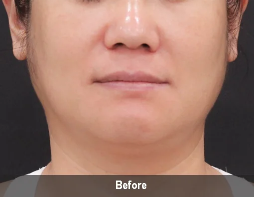 Коррекция овала лица с аппаратом Microson Plus – фото до процедуры