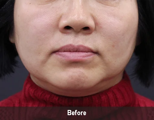 Коррекция овала лица с аппаратом Microson Plus – фото до процедуры