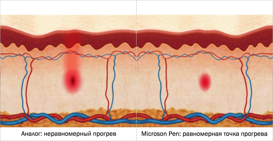 Microson Pen: технология Microson Precision